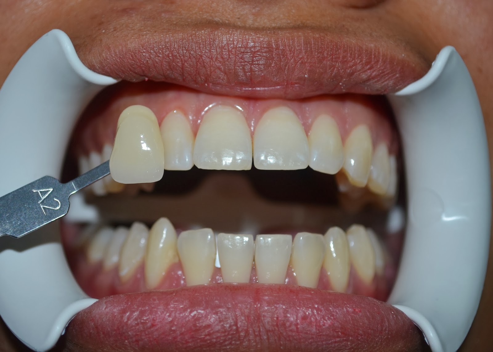 KLINIK PERGIGIAN NOORAZLINA Successful Stories to Share On Teeth